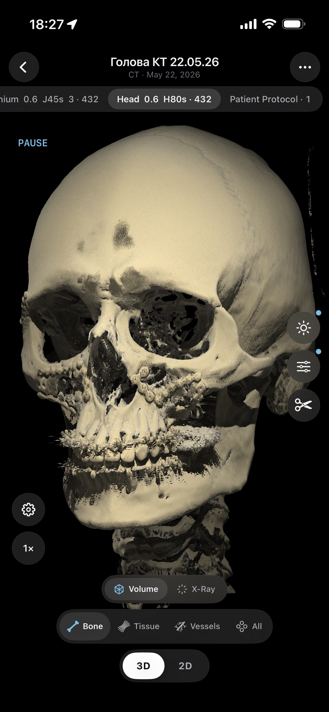3D CT reconstruction of a skull, bone preset