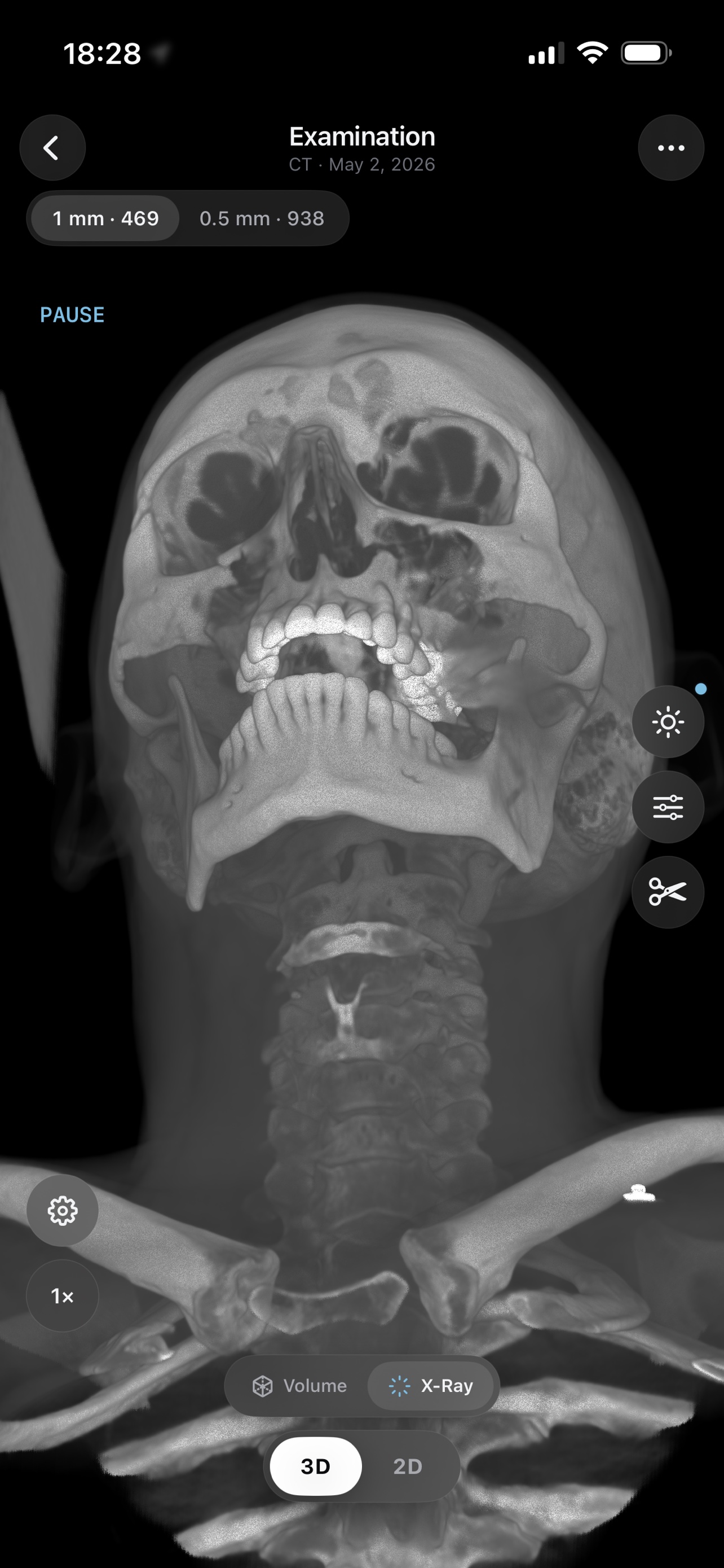 MPR sagittal slice — a side view reconstructed from the CT volume