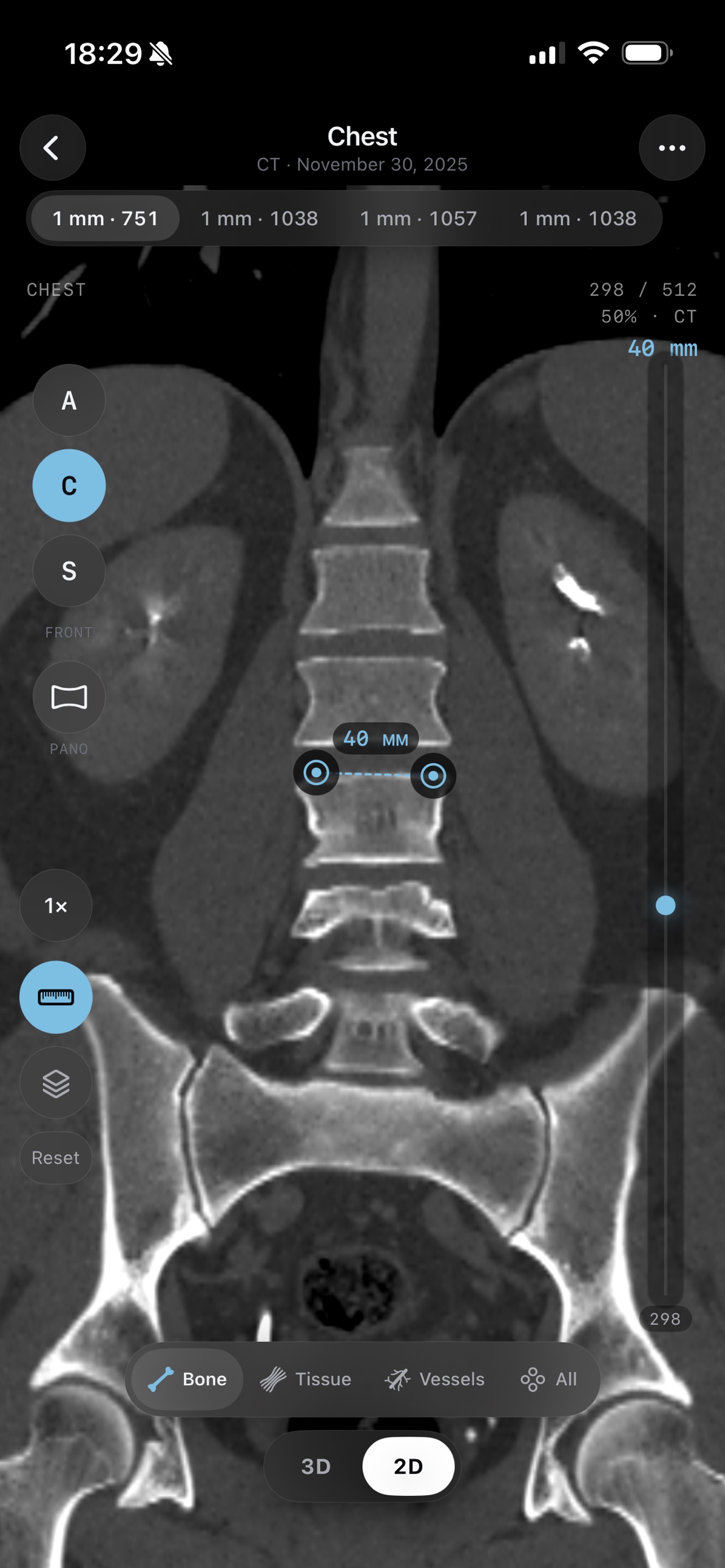 2D CT slice — coronal view with tissue preset