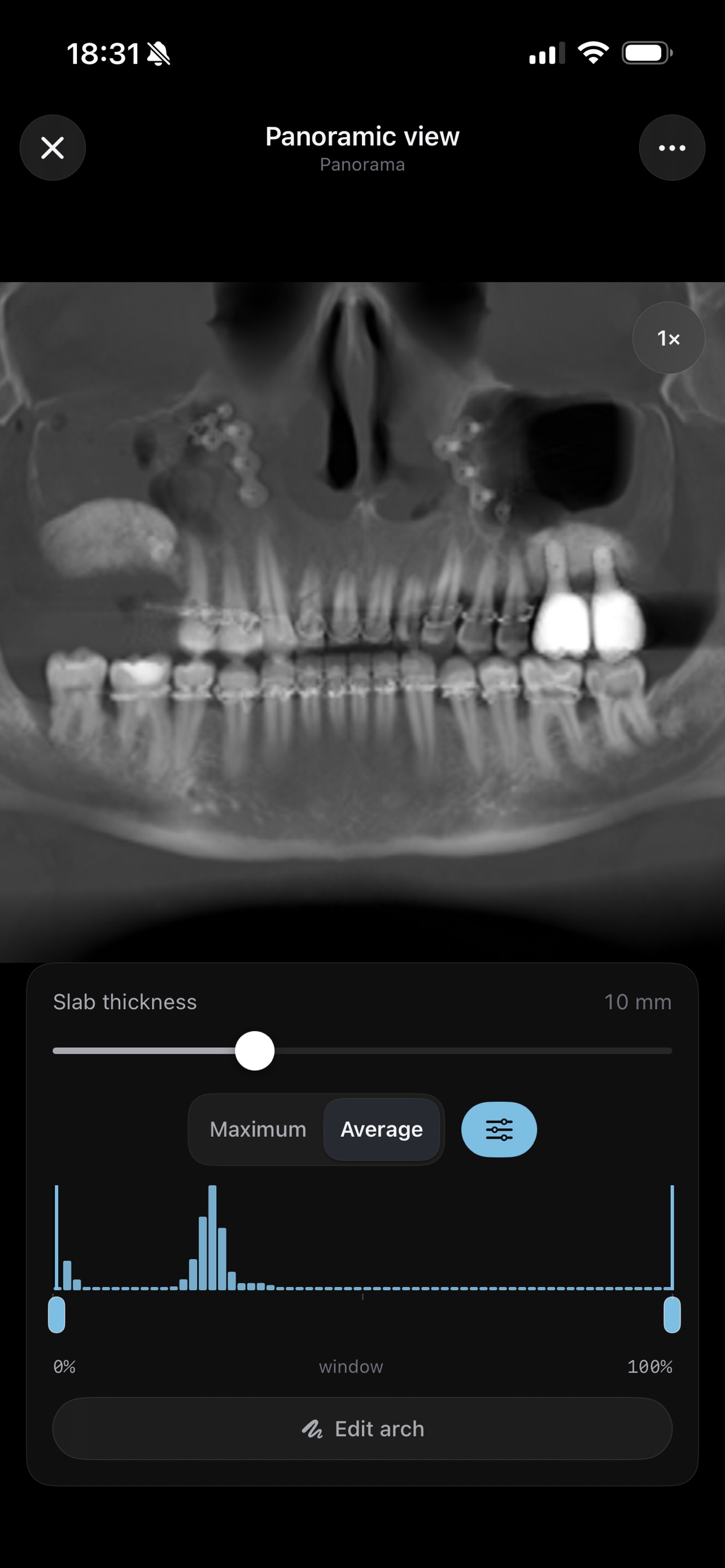 Panoramic dental view reconstructed from a 3D CT scan, with slab thickness control
