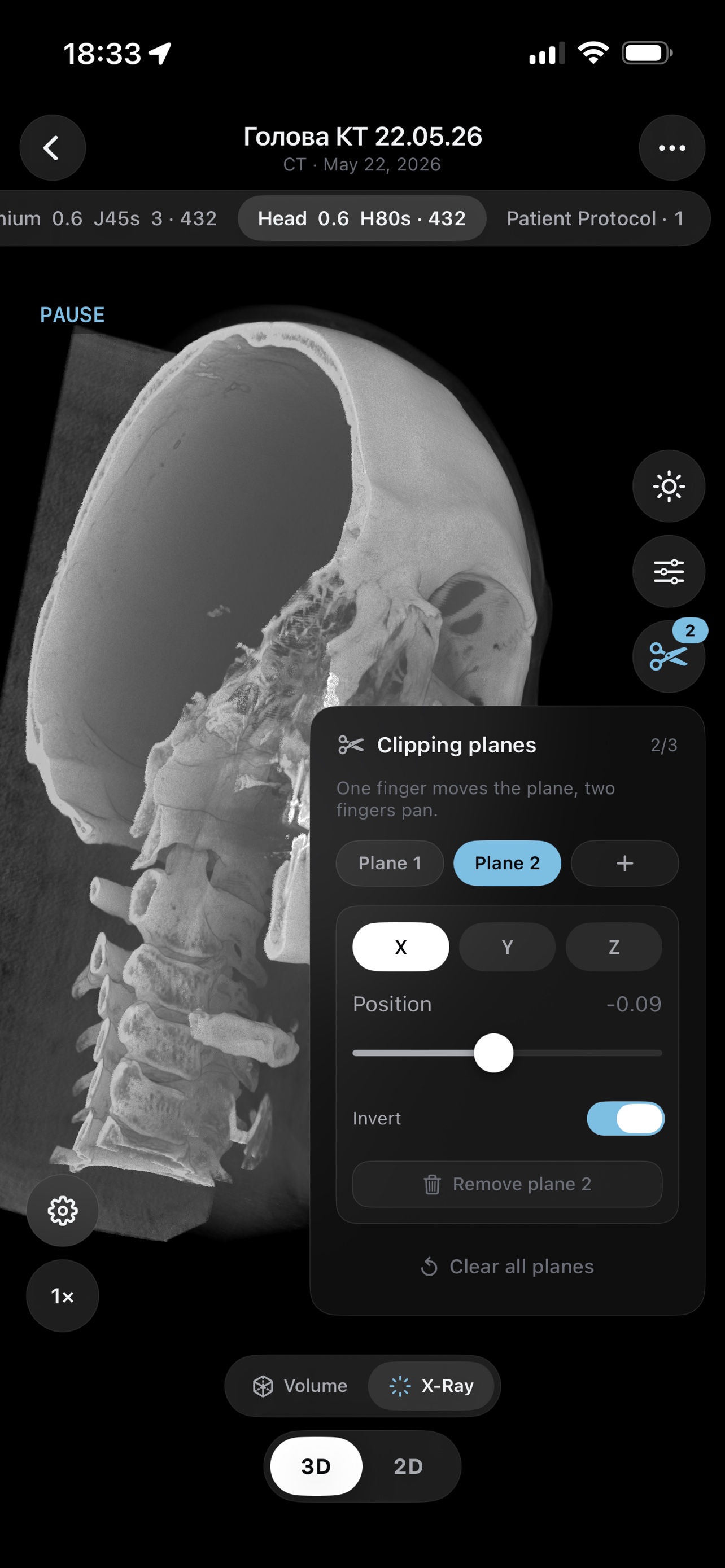 3D skull with clipping planes panel