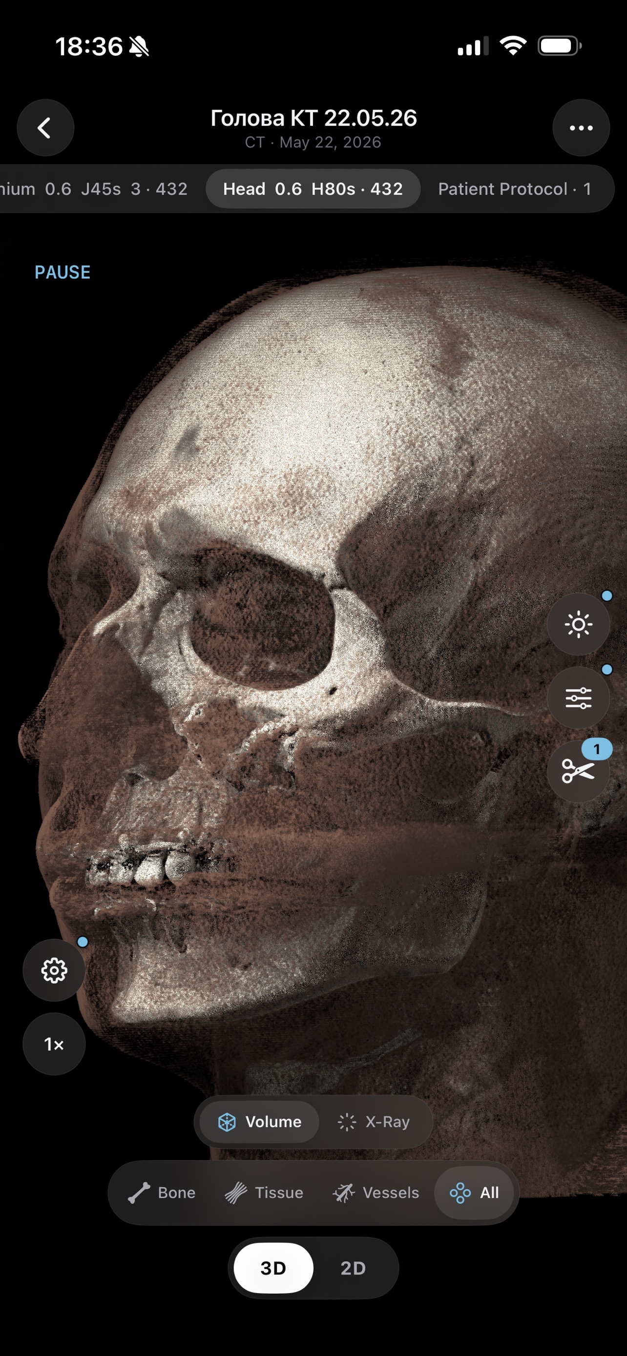 3D CT skull — volumetric realistic render