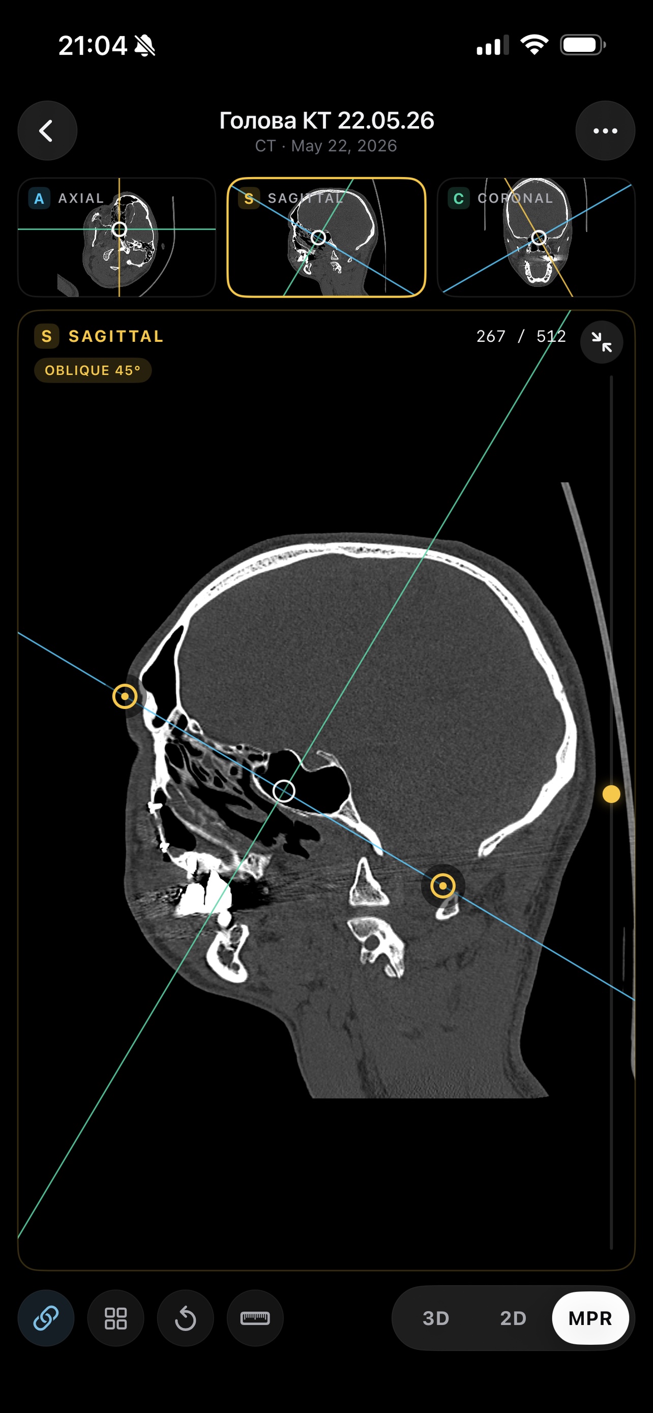 MPR focus layout — one plane enlarged with a thumbnail strip