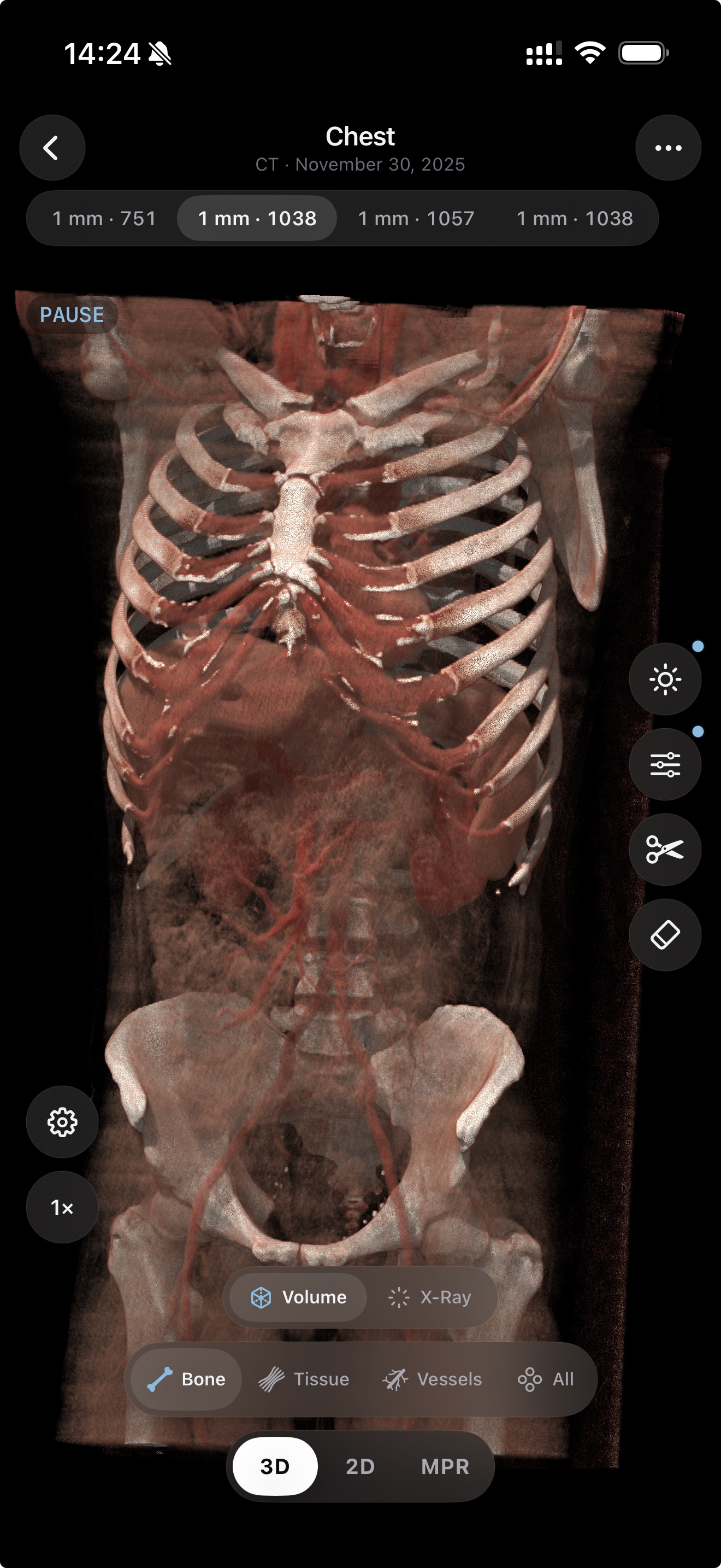 3D chest CT — bone preset with the PRO transfer-function curve colouring ribs and vessels