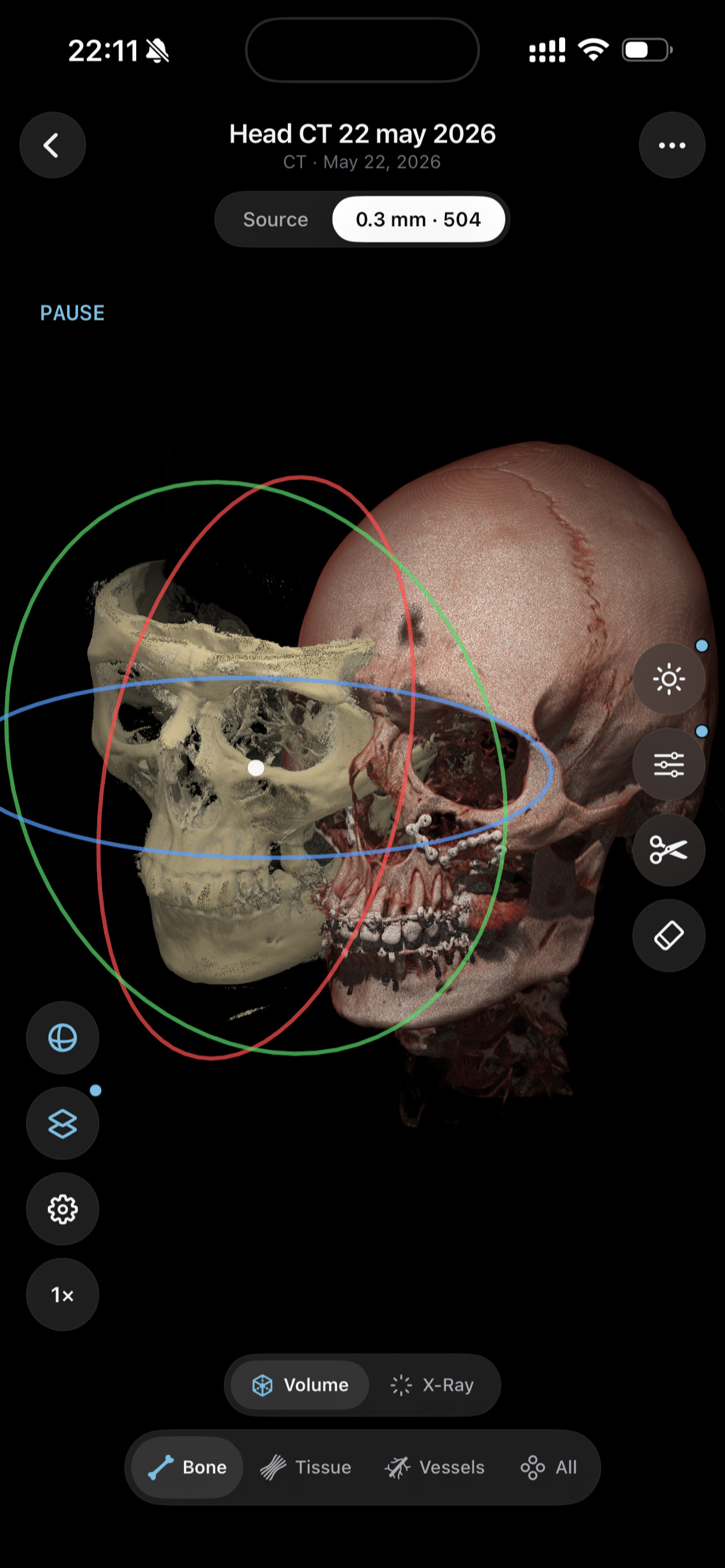 Overlay mode — a second 3D skull fused over the first with XYZ rotation rings for manual alignment