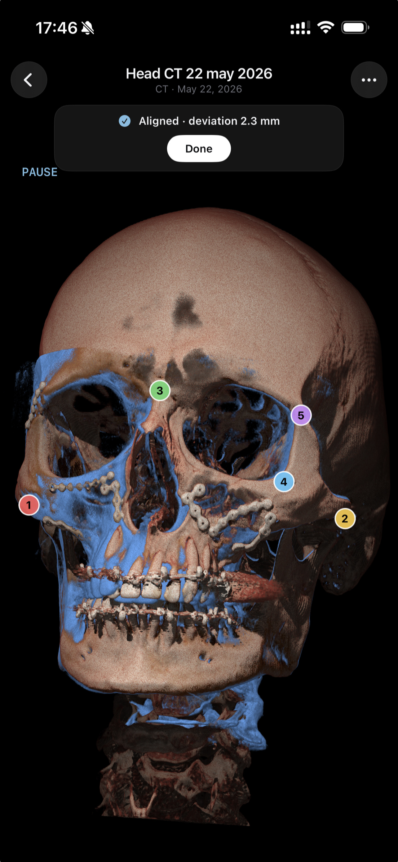 Two skull CT scans aligned by point registration, with numbered landmark points and a deviation readout in millimetres